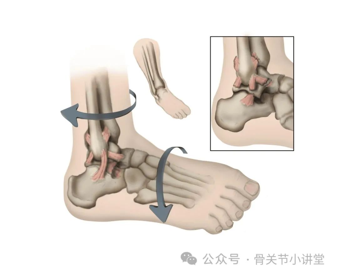腿部骨折肌肉脚踝锻炼有用吗_脚踝骨折怎样锻炼腿部肌肉_腿骨折脚踝疼