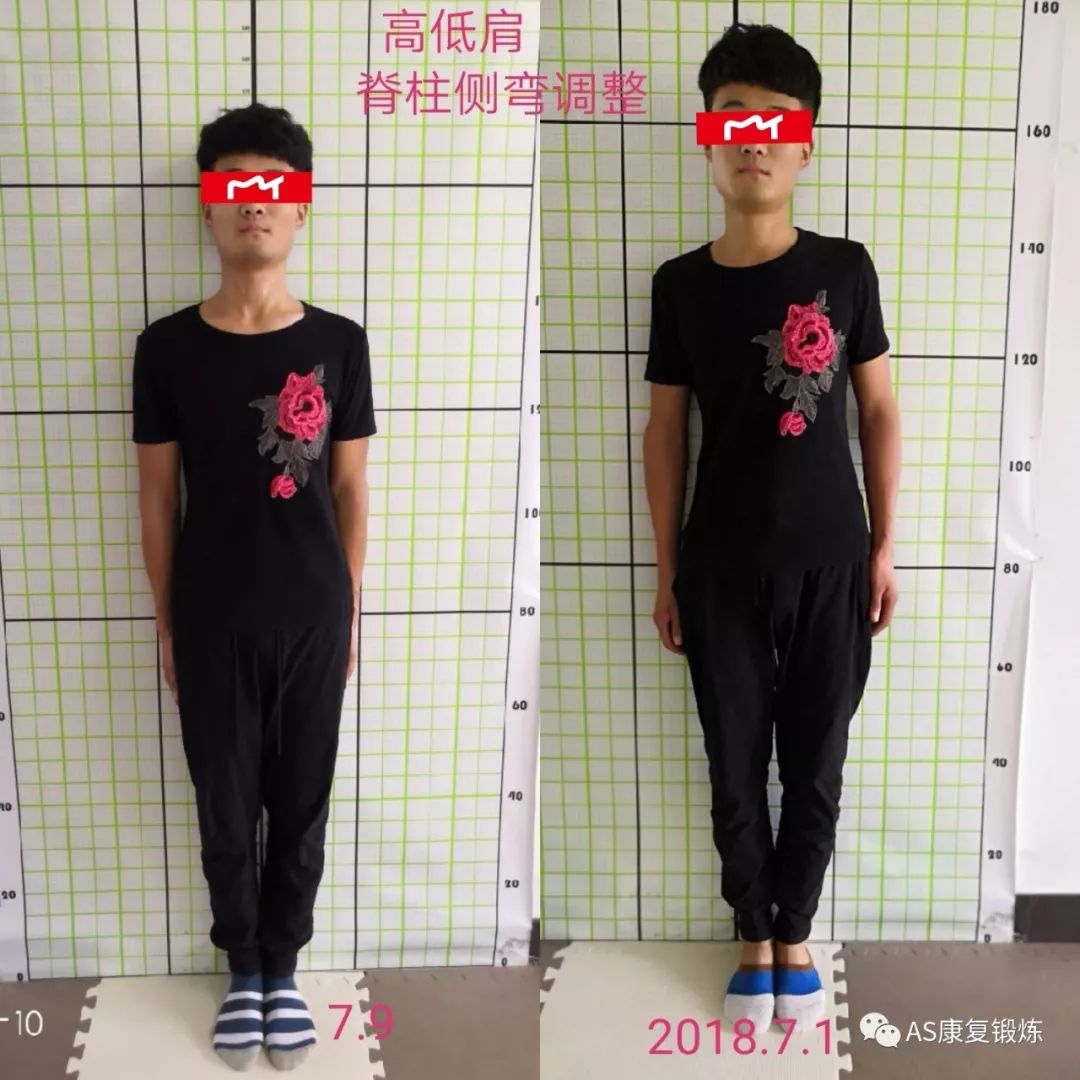 张嘉译如何锻炼强直_有锻炼好了的吗强直吧_腰椎强直怎么锻炼