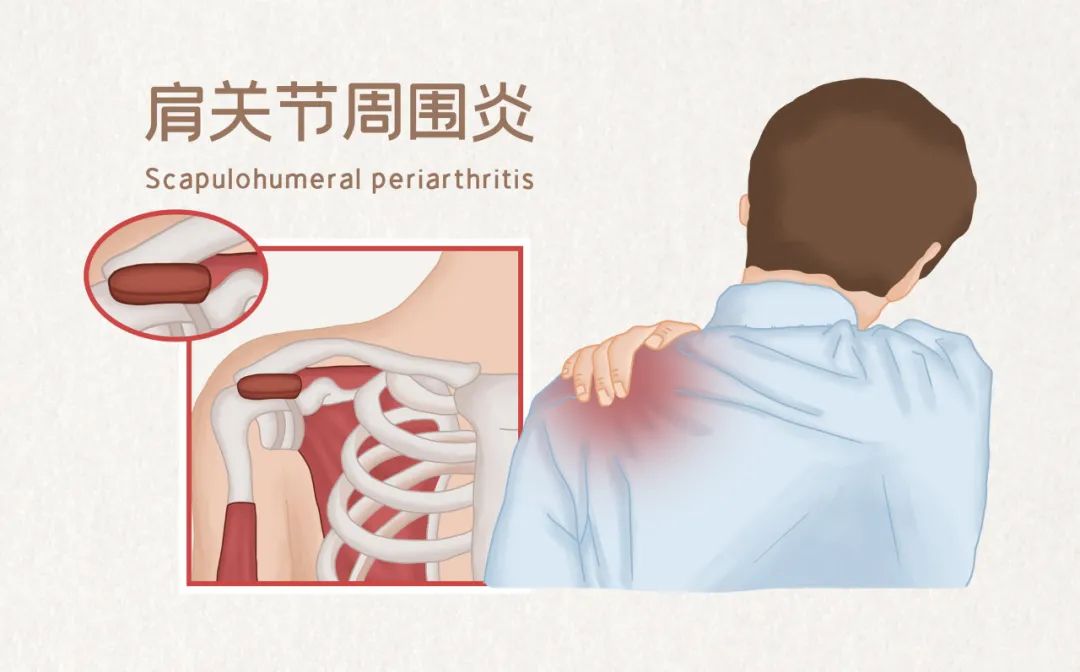 肩周炎怎么锻炼方法_锻炼肩周炎方法有哪些_锻炼肩周炎方法图解